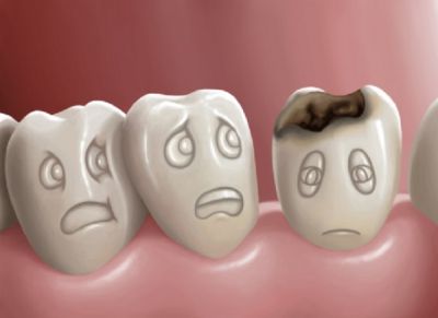 Bệnh sâu răng nguy hiểm như thế nào ?